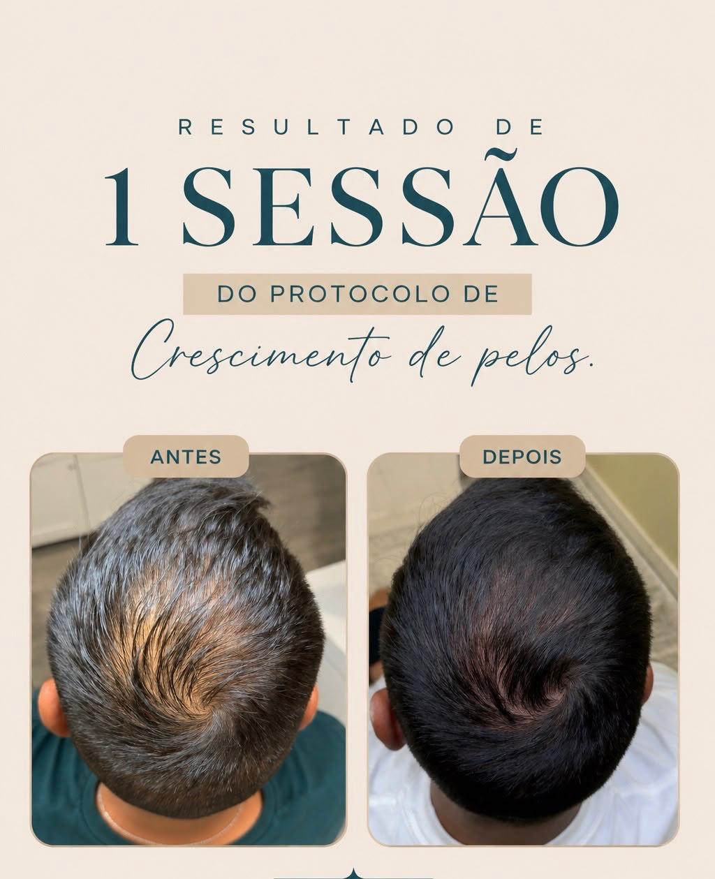 Resultado de uma sessão do protocolo de crescimento de pelos, antes e depois